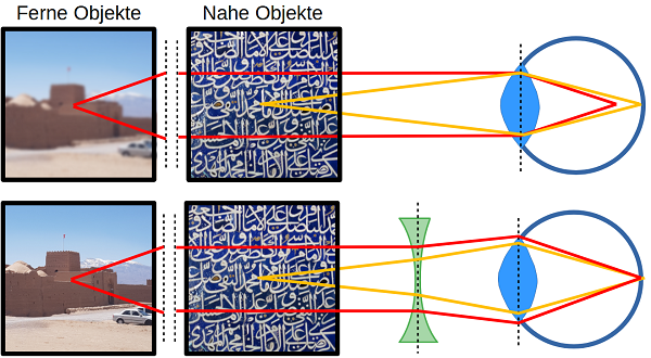 Kurzsichtigkeit